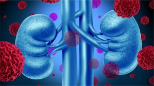 Día Mundial del cáncer renal: la importancia de conseguir un diagnóstico a tiempo