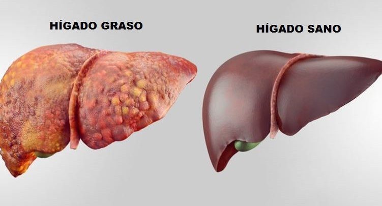 Científicos trabajan para combatir el Nash, una patología de hígado 1 04 3 751x405