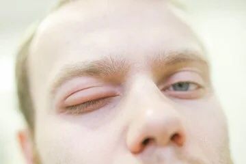 Angiodema hereditario: ¿qué es y cómo afecta en la calidad de vida de las personas que lo padecen? 1 AEH.jpg