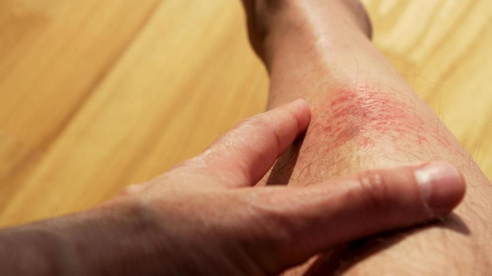 ¿Cómo cuidarse del sol en verano? 1 alergia.jpeg