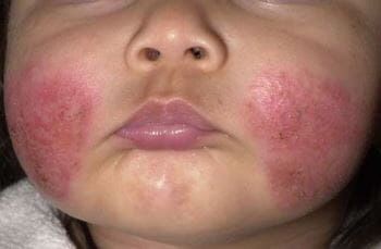 dermatitis_atopica.jpg