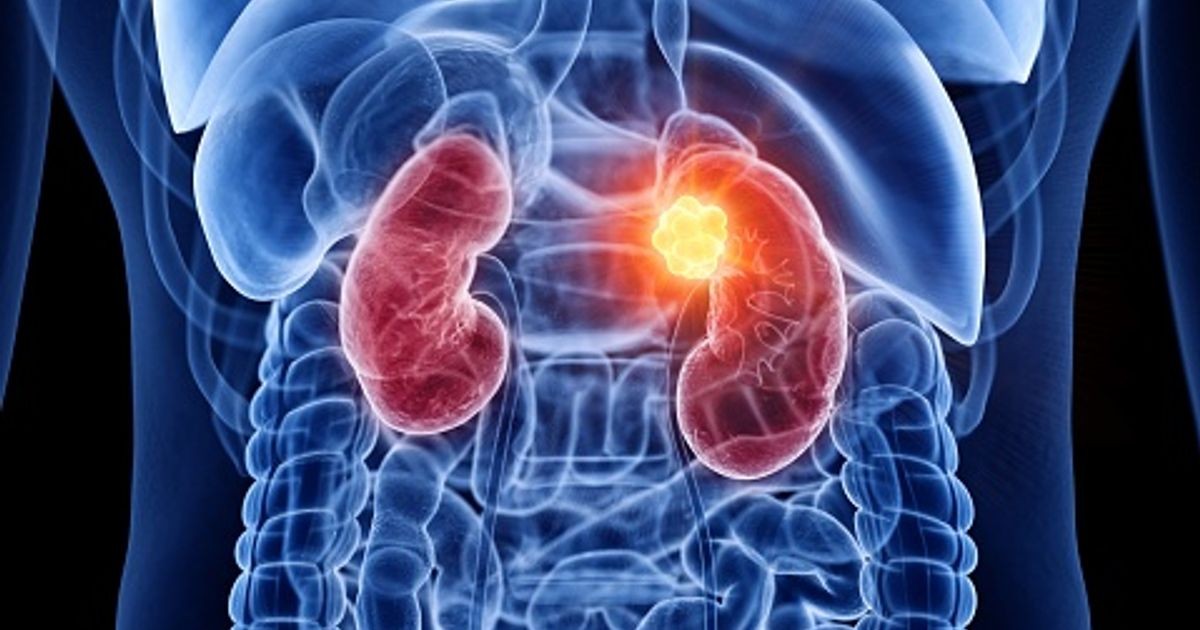 dia_mundial_del_cancer_renal.jpg