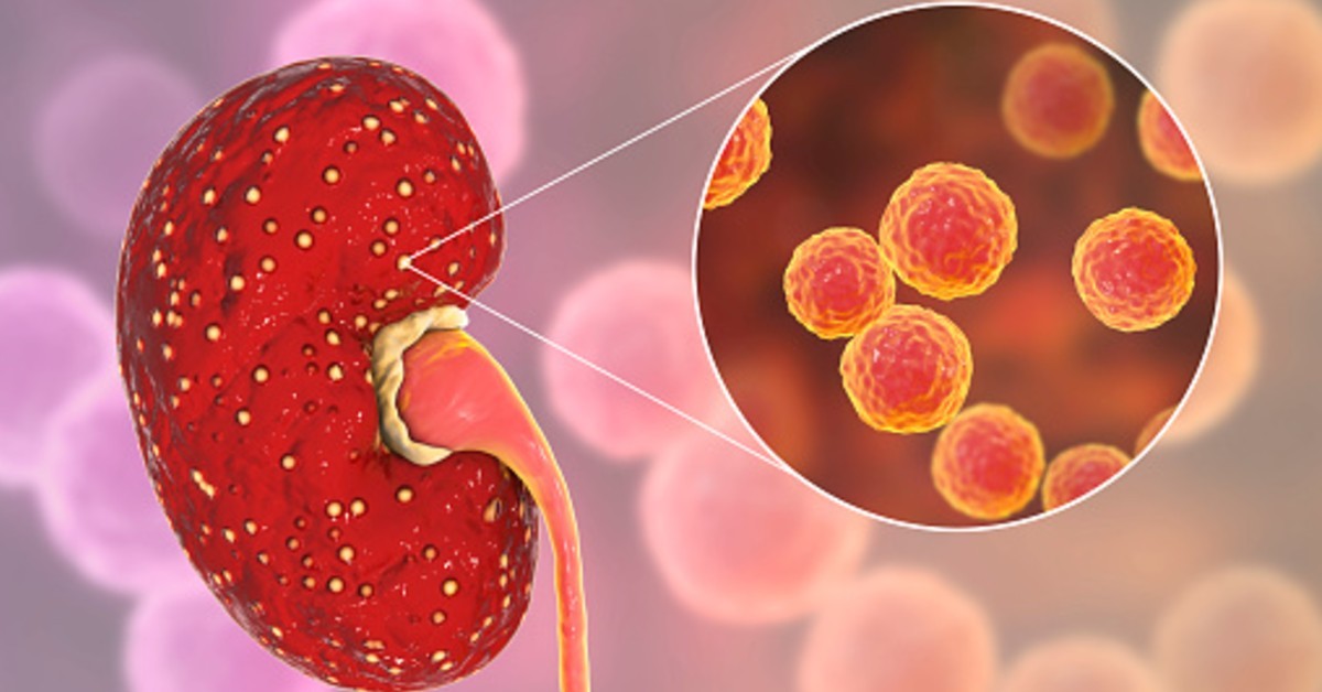 Cáncer de Riñón: la importancia del diagnostico temprano 1 diagnostico_cancer_renal.jpg